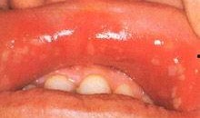 口腔溃疡新闻爆料,专家提醒关注口腔健康问题